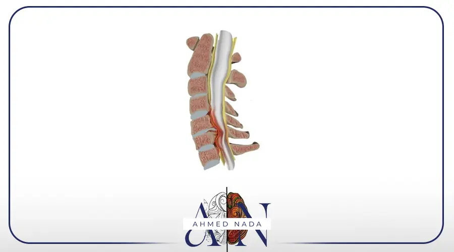 ضيق القناة العصبية العنقية