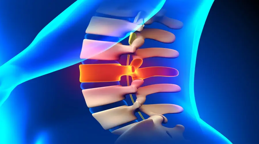 عملية استئصال الغضروف القطنى