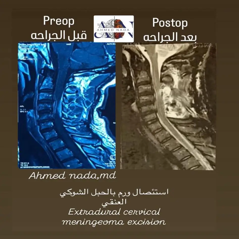 استئصال أورام العمود الفقري والنخاع الشوكي بالميكروسكوب