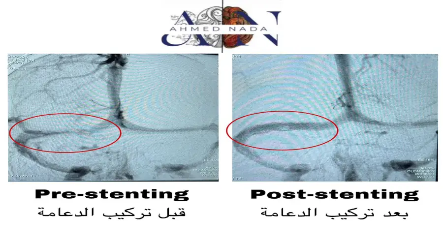 تركيب دعامة في الباب الوريدي المستعرض