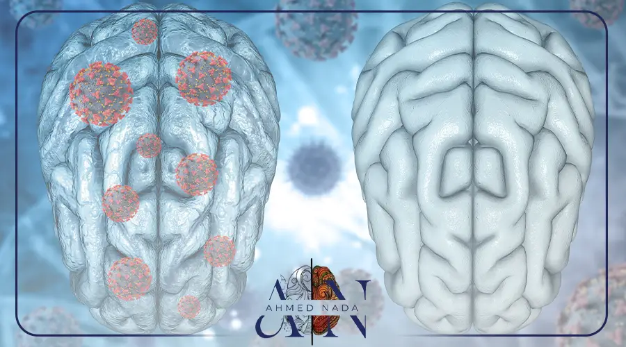 افضل دكتور اورام المخ